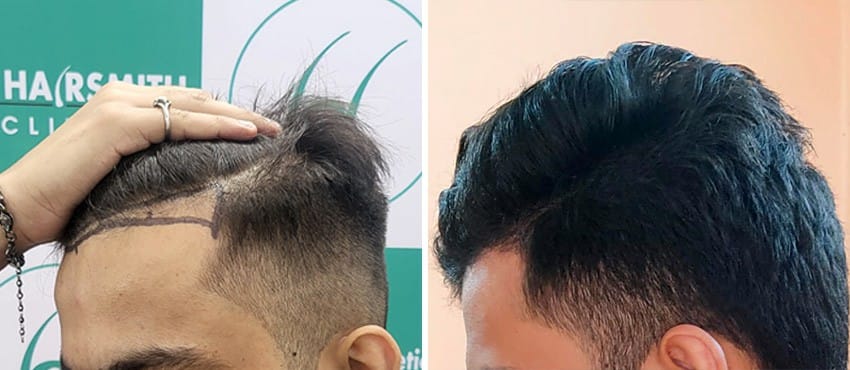 hair transplant before after results