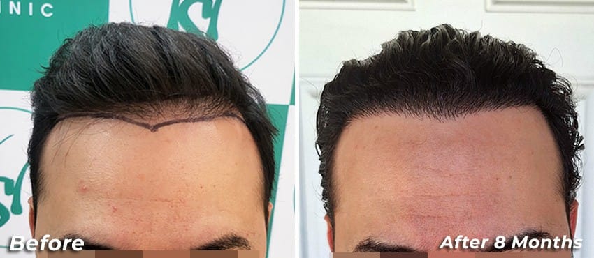 Hair Transplant in Delhi