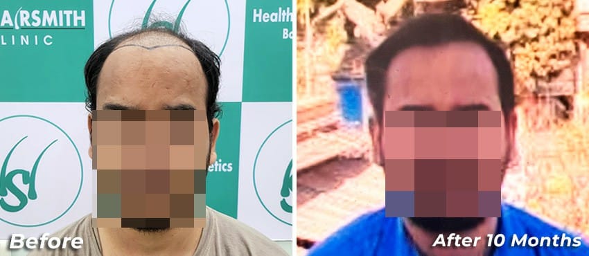 10 months hair transplant results