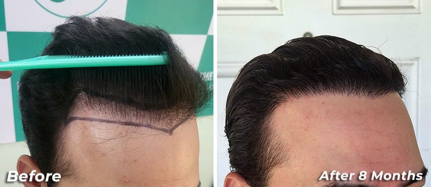 8 months hair transplant results