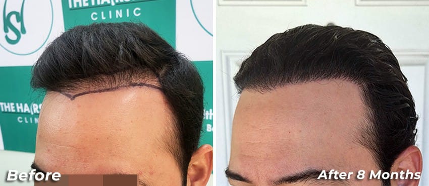 08 months hair transplant results