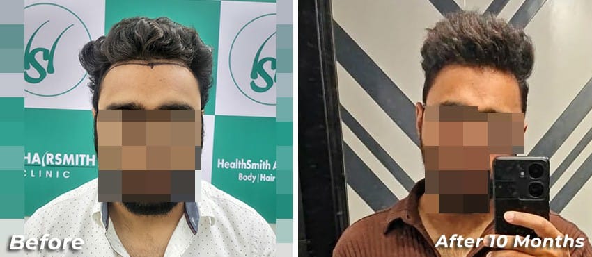 10 Months Hair Transplant Result at the hairsmith clinic