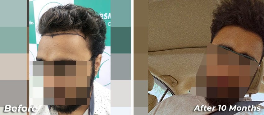 10 months hair transplant result at the hairsmith clinic