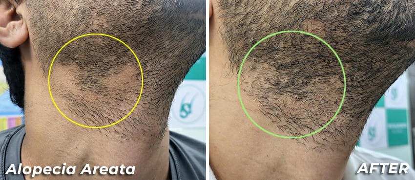 best hair transplant delhi