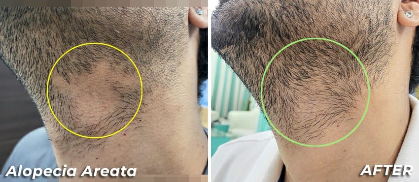 best hair transplant in delhi