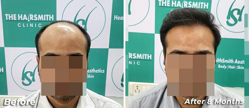 8 month hair transplant results