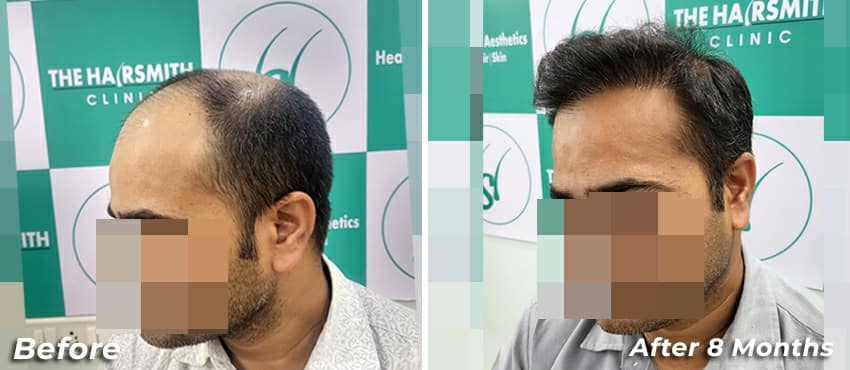 8 months hair transplant results