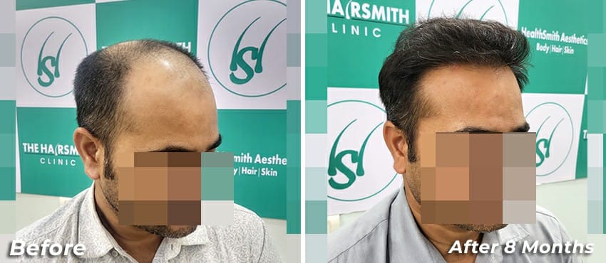hair transplant results before and after