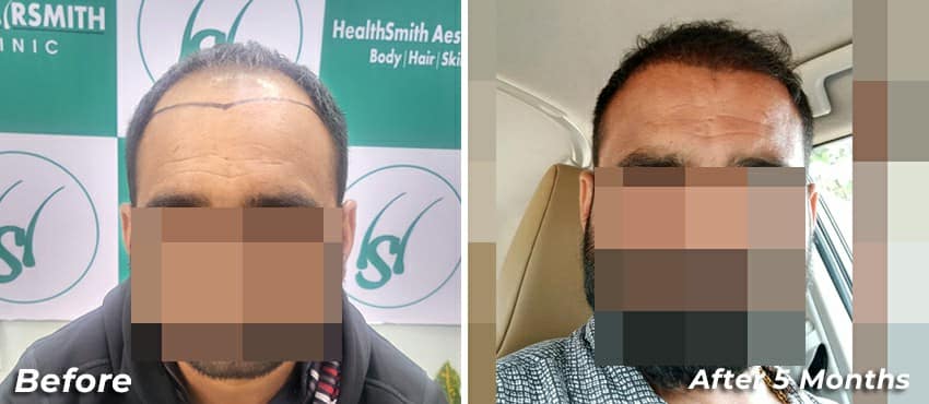 best hair transplant in delhi