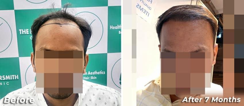 best hair transplant result delhi