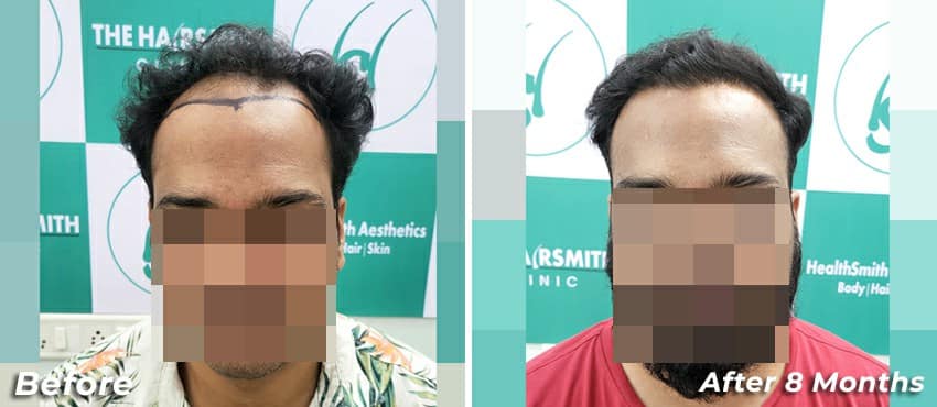 hair transplant before and after