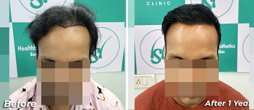 best hair transplant results