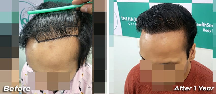 hair transplant amazing results