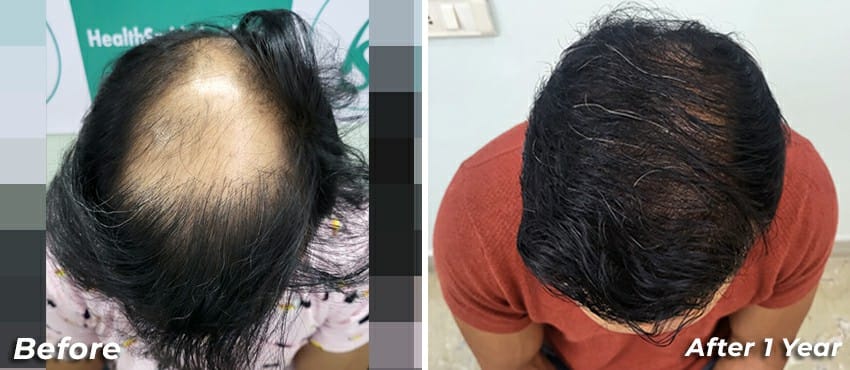 best hair transplant results in india