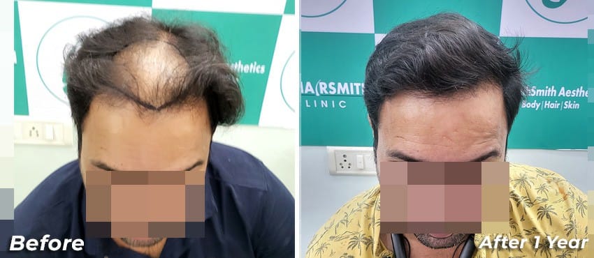 good hair transplant results
