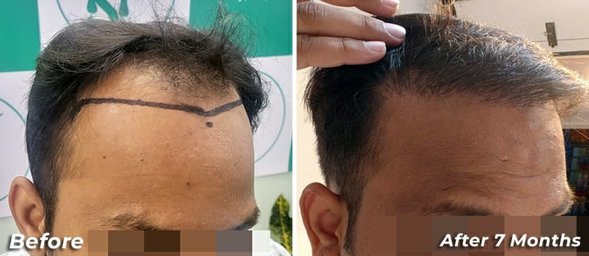 hair transplant results