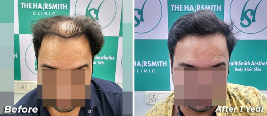 hair transplant results in india