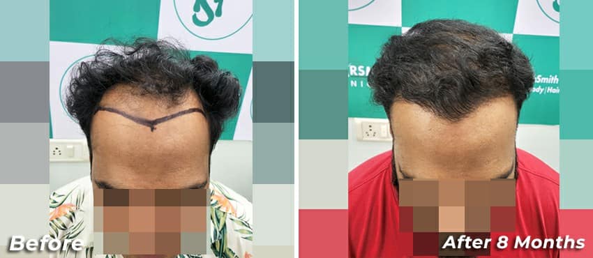 hair transplant before and after