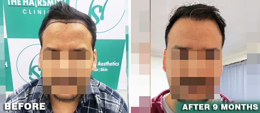 hair transplant in delhi