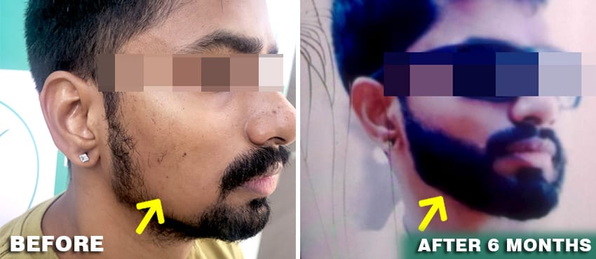 beard transplant result