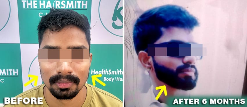 beard hair transplant india