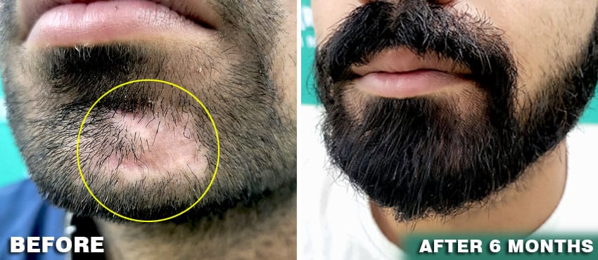 beard hair transplant cost