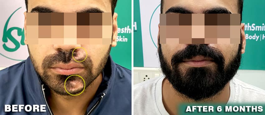 beard hair transplant cost delhi