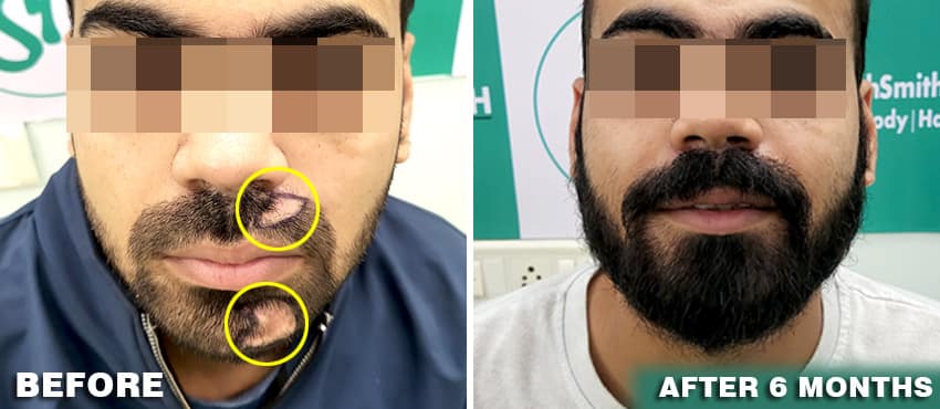 beard hair transplant results