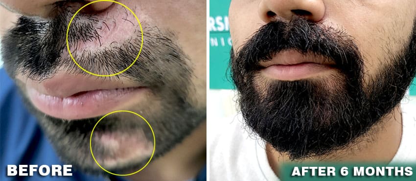 beard hair transplant delhi