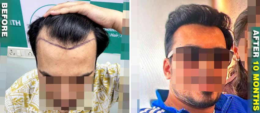 full head hair transplant result