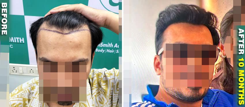 fue hair transplant result