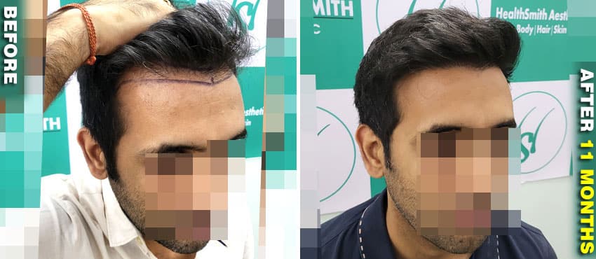 long term hair transplant result