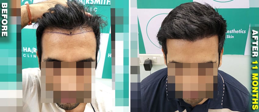 hair transplant result images
