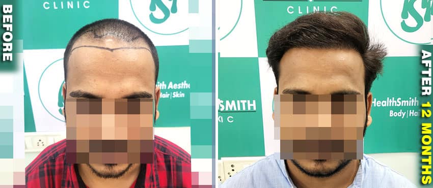 hair transplant result