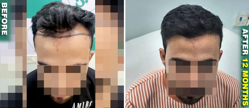 hair transplant result before and after