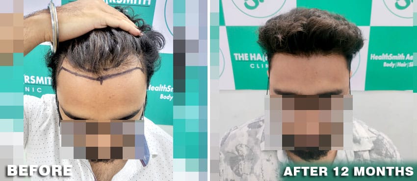 result of hair transplant