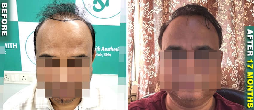 hair transplant full results