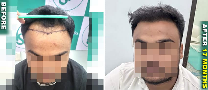 day by day hair transplant result