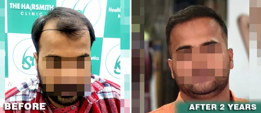 full result after hair transplant