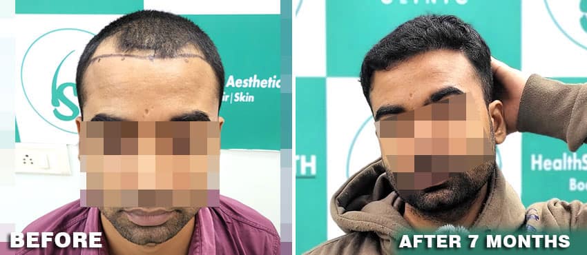 best hair transplant result