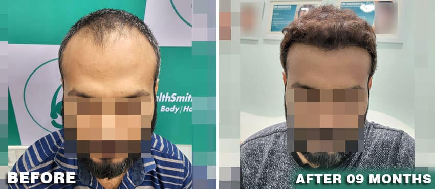hair transplant amazing results