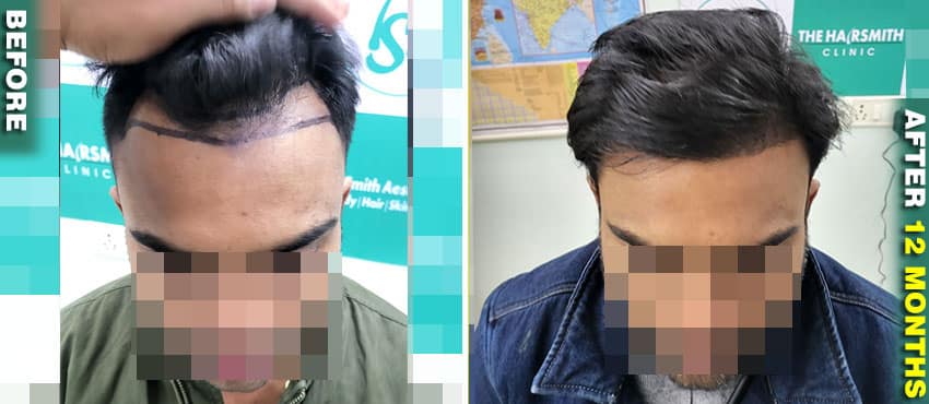 ur fue hair transplant result