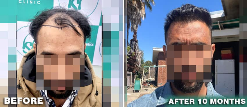 hair transplant result