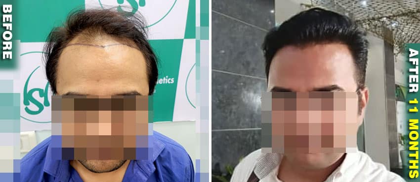 good hair transplant result