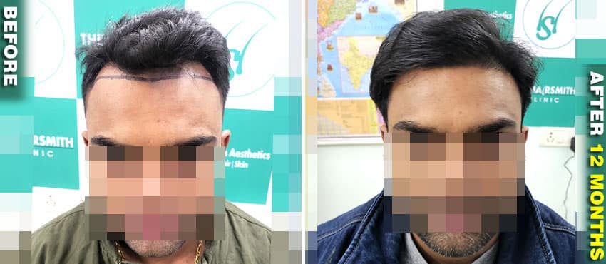 after hair transplant result