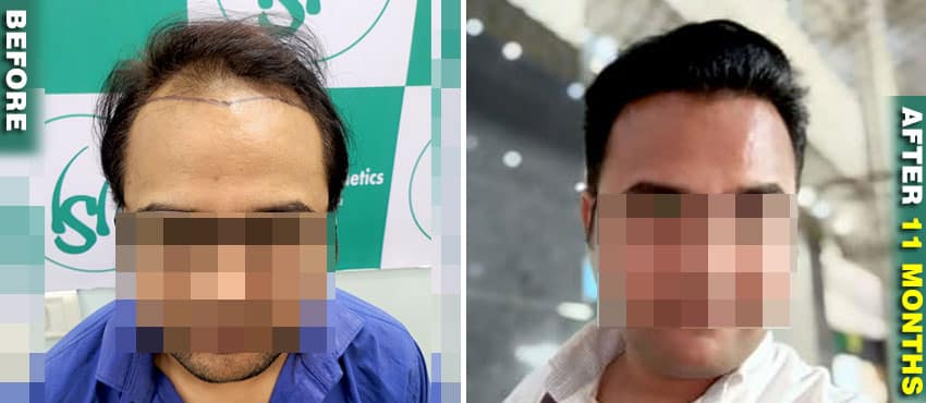 hair transplant good results