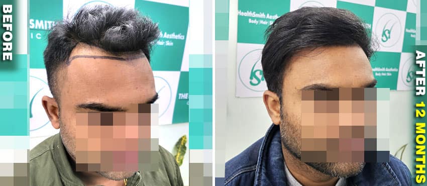 amazing hair transplant result