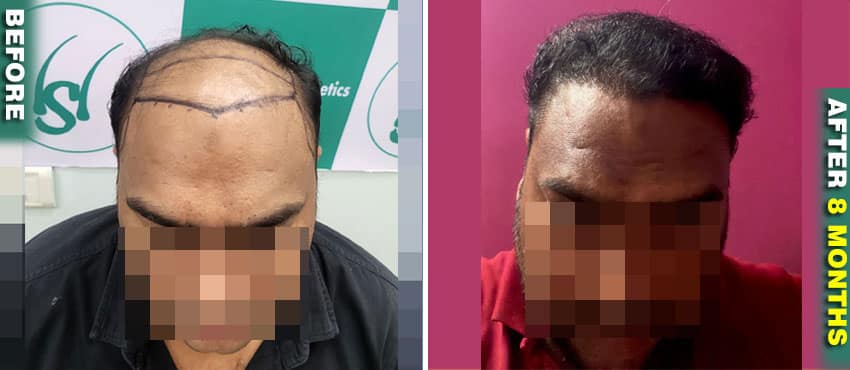 hair transplant results long hair