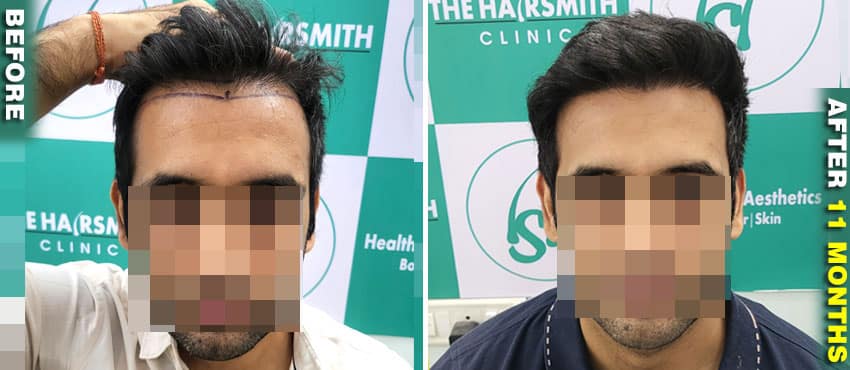 hair transplant result before and after