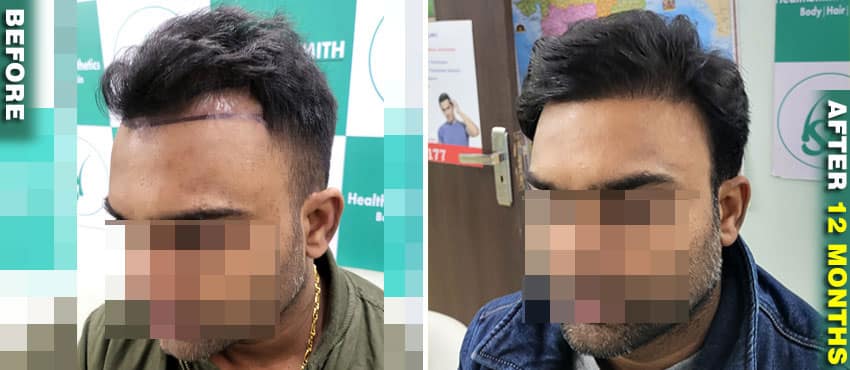 hair transplant results best